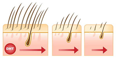 Caduto capelli ragioni ormonali