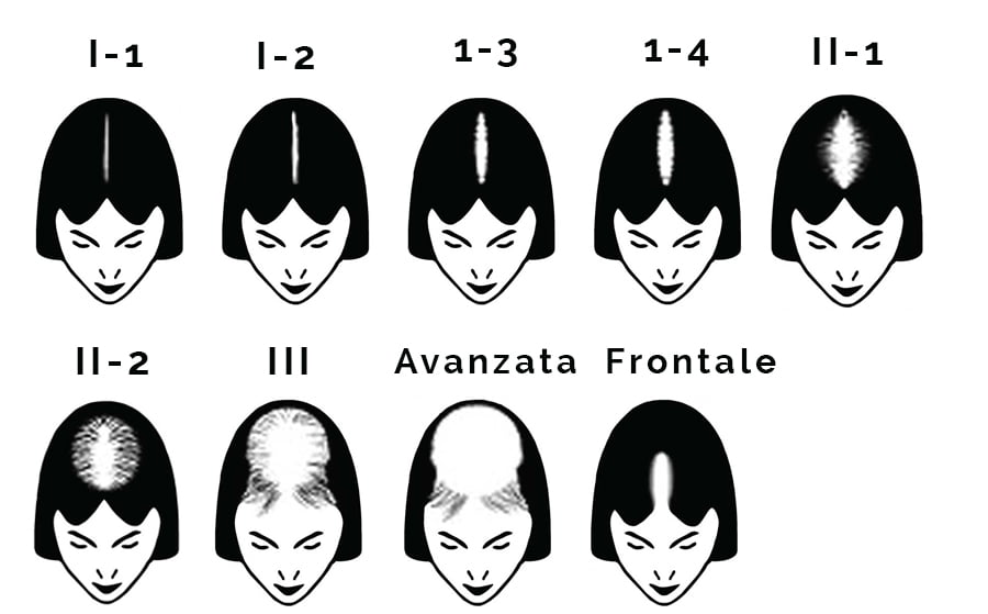 Classificazione Calvizie Donne